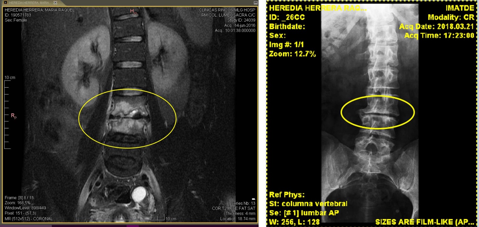 HERNIAS DISCAL EXIALOE