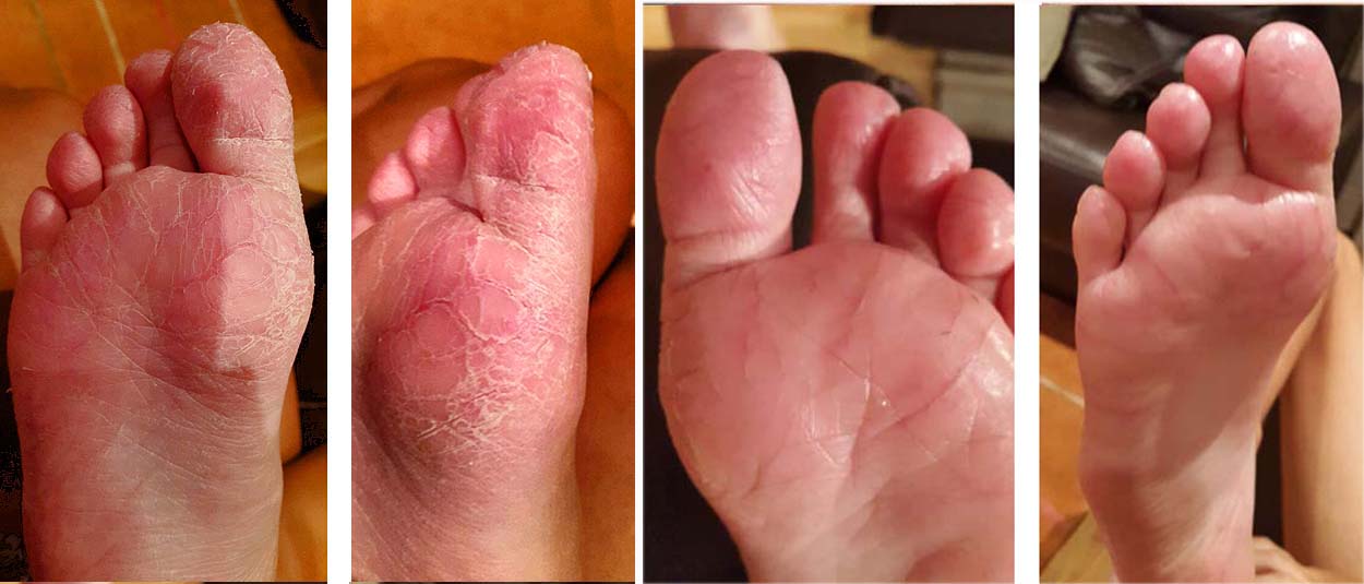 dermatitis plantar crónica curada con aloe vera